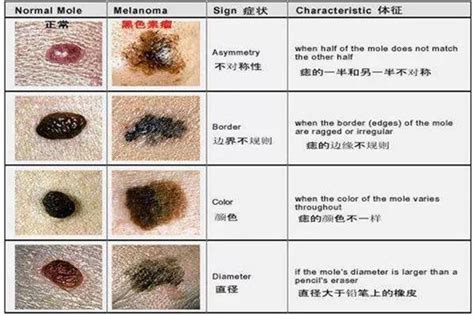 新生兒痣|宝宝身上有痣症状